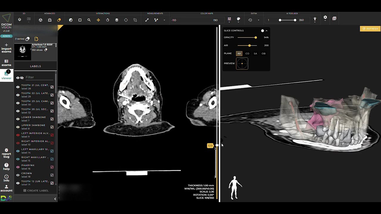 AI Dental Segmentation in DICOM Vision: TotalSegmentator + ToothFairy Demo #1