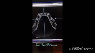 CBCT demonstration of Bifid Mandibular Canal by Dr Nyer Firdoose