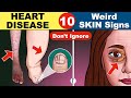 10 skin signs of heart disease  coronary artery disease  heart failure  heart attack