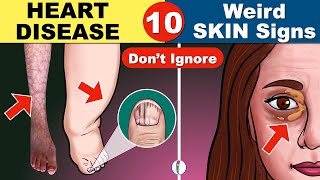 10 Skin Signs of Heart Disease | Coronary Artery Disease | Heart Failure | Heart Attack