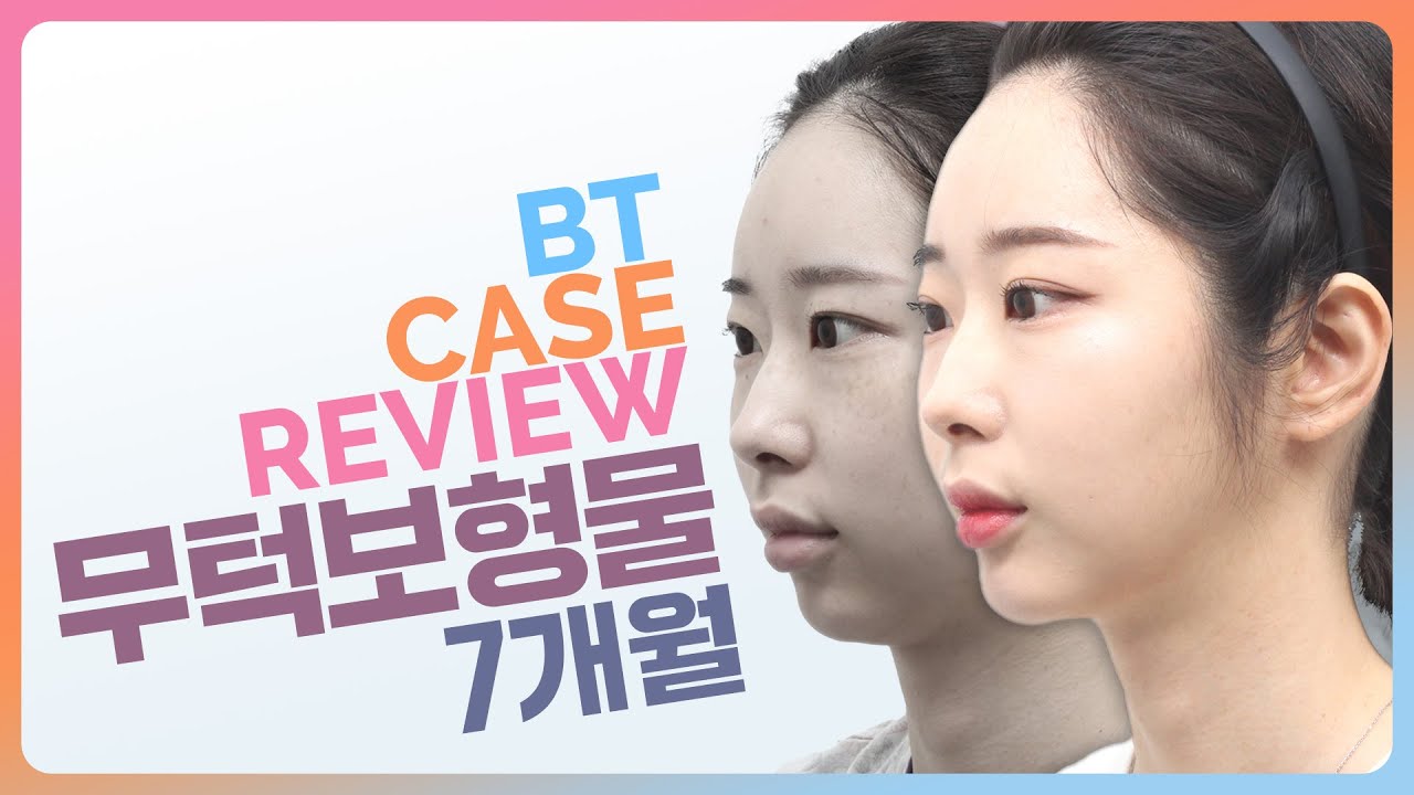 무턱 보형물 수술 케이스 리뷰ㅣ비티성형외과
