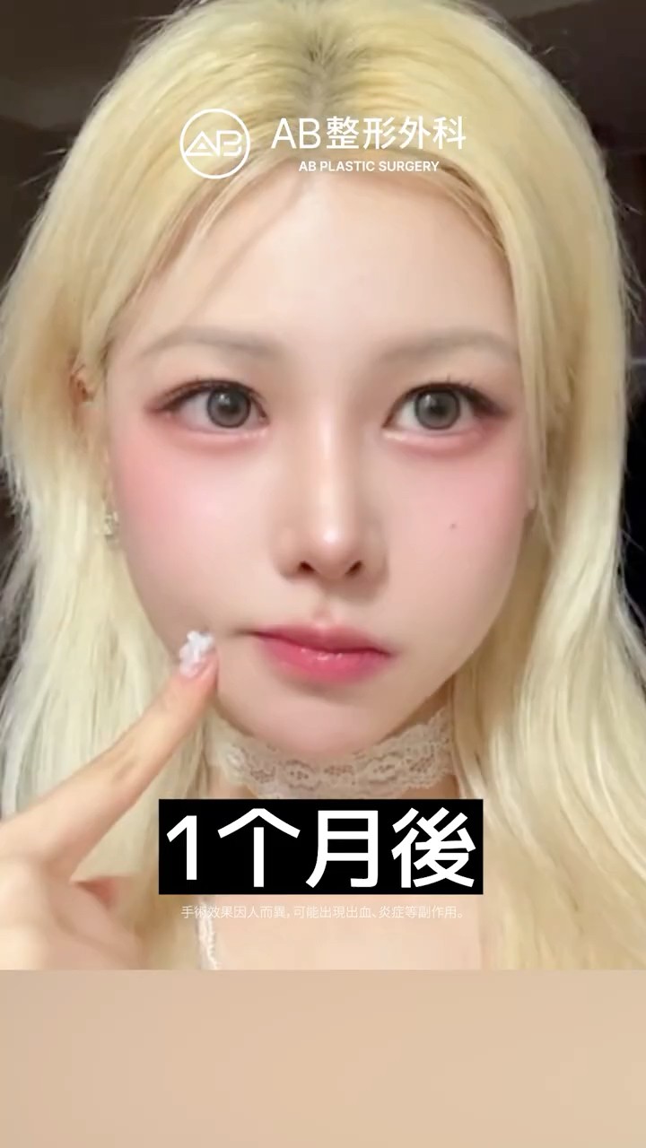 輪廓三件套、眼整形、鼻整形前後對比一次看✨ #Shorts