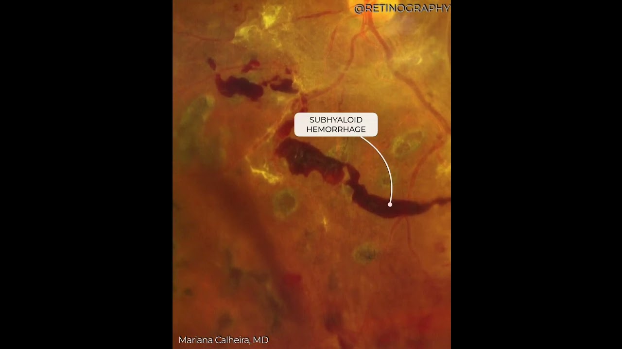 PROLIFERATIVE DIABETIC RETINOPATHY #retina #oftalmo #ophthalmology #oftalmologia #oftalmologÃ­a #oph