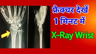 Fracture Distal Radius Case-2 X-Ray Wrist Udayxray