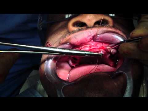 Alveoloplasty Part 2/2 - Immediate Denture