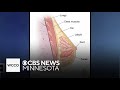 This lesser known type of breast cancer is on the rise among U.S. women