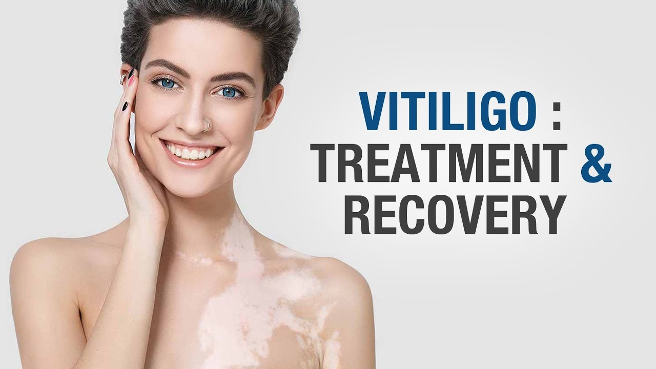 new research vitiligo cure