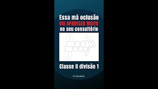 Tratamento De Classe Ii Divisão 1