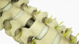 Anterior cervical discectomy and fusion (ACDF)