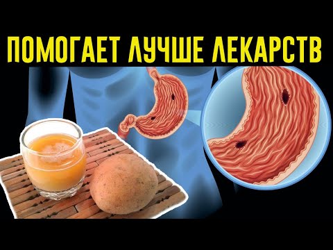 КАК ВЫЛЕЧИТЬ ЯЗВУ ЖЕЛУДКА И ГАСТРИТ ЗА 10 ДНЕЙ КАРТОФЕЛЕМ!