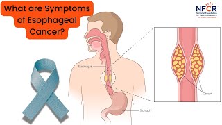 Esophageal #Cancer and the Symptoms to Watch For