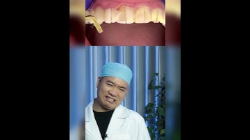 Cắt cầu răng sứ và cái kết #shorts