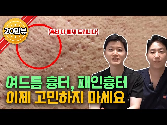 패인 여드름 흉터 없애는 가장 혁신적인 레이저가 나왔습니다 / 흉터치료 고민 끝
