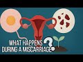 What happens during a Miscarriage | Causes, Myths & Safe Treatment