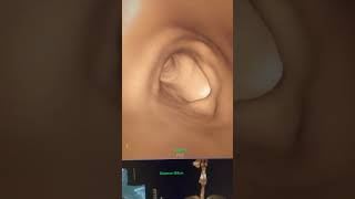 Explaining the Virtual Bronchoscopy Technique Using CT Scans screenshot 1