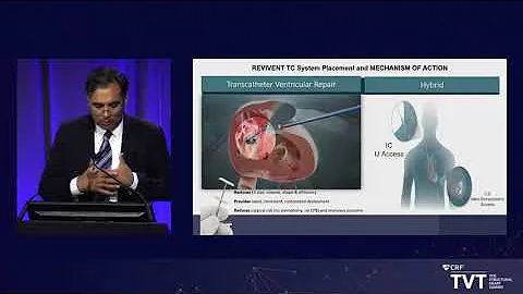 TVT.21 | Dr.  Jerry Estep (Cleveland Clinic) | LIV...