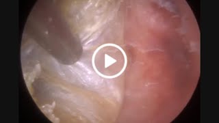 картинка: 939 - Обтурирующий кератоз: случай из практики