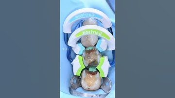 Composite restoration  36, 37 with the new matrix system Strata-G #dentist #dentalclinic #dentistry