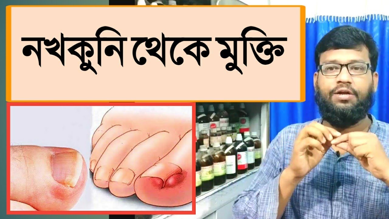 নখকুনি থেকে মুক্তি হোমিওপ্যাথি ঔষধে | Nail Skin infection homeopathy medicine