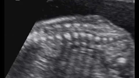 Come si cura la spina bifida occulta?
