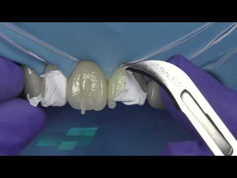 GC's Direct Restorative Solutions - Injection Molding Technique