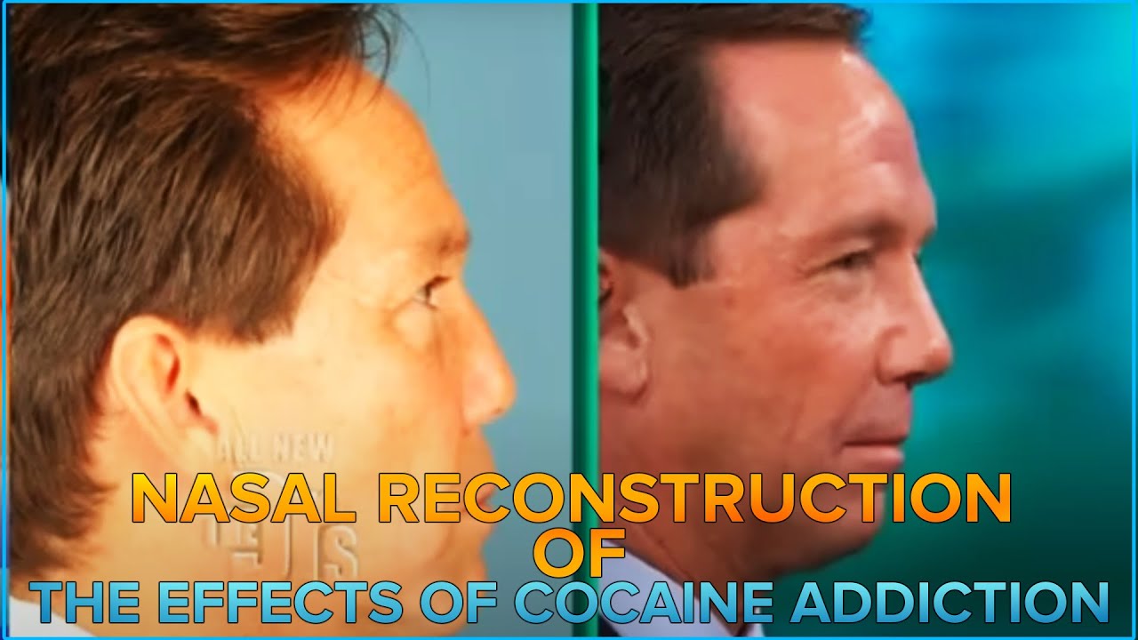 Dr Jay Calvert Revision Rhinoplasty Nasal Reconstruction Of The dr-jay-calvert-revision-rhinoplasty-nasal-reconstruction-of-the