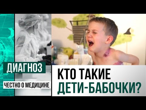 Видео: Может ли развиться дистрофический буллезный эпидермолиз?