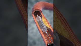 How Doctors Open Blocked Arteries (Angioplasty Step-by-Step)