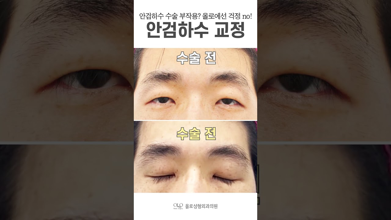 [OLLO Plastic Surgery Clinic] #mắt buồn ngủ #mắt chảy xệ Sụp mí mắt #tác dụng phụ Đừng lo lắng tại Ollo #no #shorts | Chuyên gia phẫu thuật thẩm mỹ | Sụp mí mắt | Mắt nam