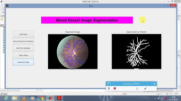 Automated Vessel Segmentation Using Infinite Perimeter Active Contour Model on Retinal Images