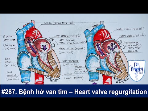# 287. Bệnh hở van tim triệu chứng và cách chữa trị
