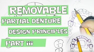 Removable Partial Denture Design Principles Part III