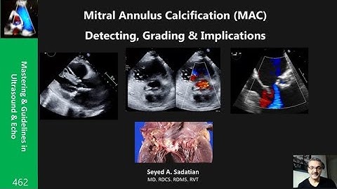 Mitral Annulus Calcification (MAC): Detecting, Grading & Implications