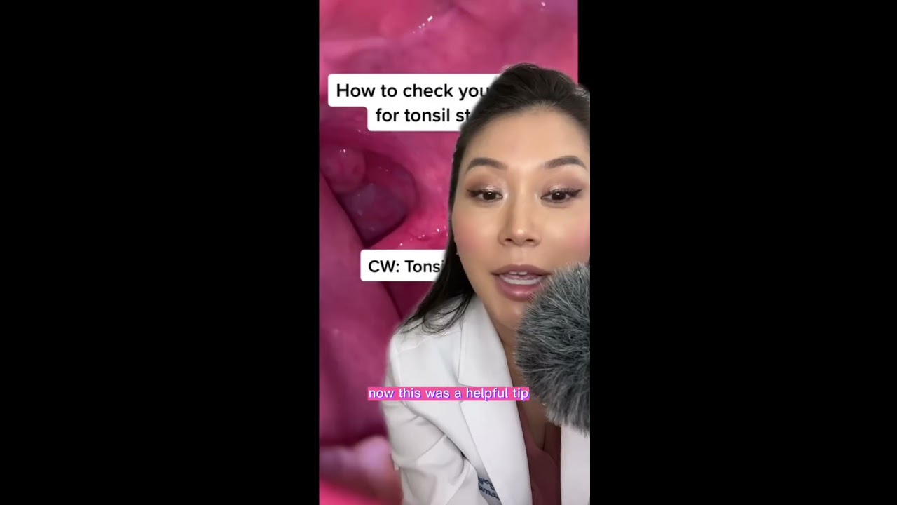 How To Tonsil Stone Removal Tonsilstones Dentist