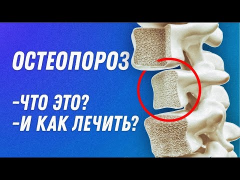 Остеопороз что это? Симптомы, Диагностика и Лечение | Остеопат Марина Просветина