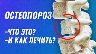 Остеопороз что это? Симптомы, Диагностика и Лечение | Остеопат Марина Просветина