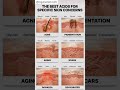 The best for specific skin concern#cosmetology #acid #skinconcerns #explorepage #explorepage  #fypシ