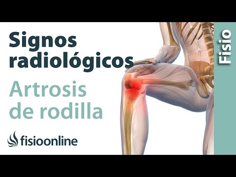 Artrosis de rodilla - Signos radiológicos