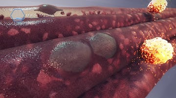 Muscle and stem cells: Repair after major trauma