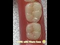 PMMA Material  Night Guard for Teeth