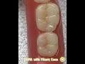 PMMA Material  Night Guard for Teeth