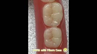 PMMA Material  Night Guard for Teeth