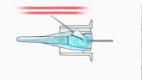 AMO Tecnis 1 ZCB00 Loading