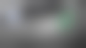 Distal Root Fracture During Wisdom Tooth Extraction @drwahan