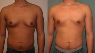 types..causes and solution of gynecomastiaانواع و اسباب و علاج التثدى في الرجال