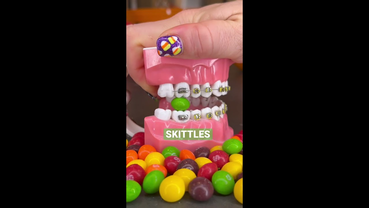 FOODS YOU CAN T EAT WITH BRACES Braces Teeth Candy Snacks Shorts