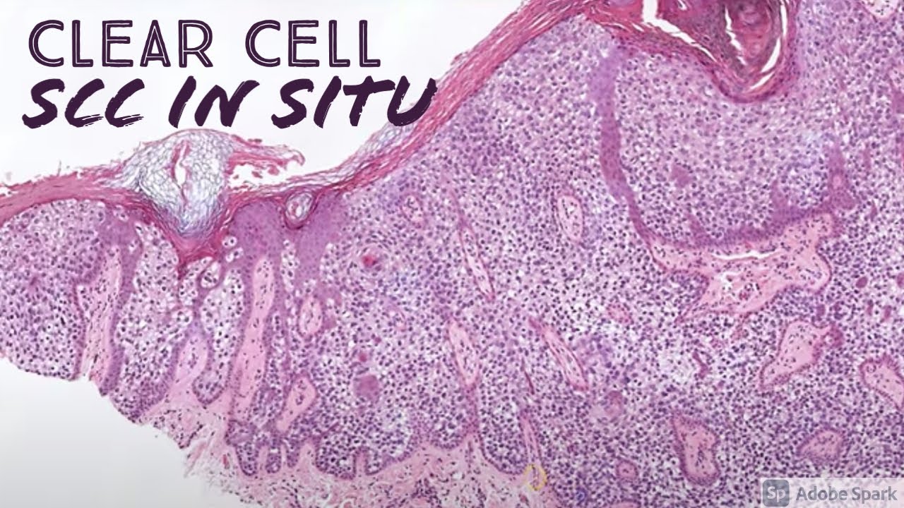 squamous cell carcinoma in situ histology