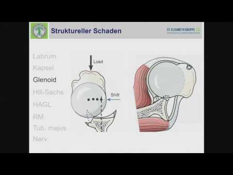 13/16 - Operative Behandlung der Schulterinstabilität - Alles Labrumläsion?