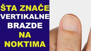 Šta znače VERTIKALNE BRAZDE NA NOKTIMA/dr Bojana Mandić