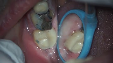 Refining a core backup on 18 video taken using a Seiler Microscope
